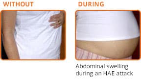 Photo of a hereditary angioedema patient without and during an HAE attack causing abdominal (stomach) swelling.