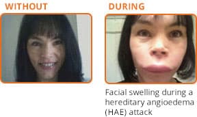 Photo of a woman without and during a hereditary angioedema (HAE) attack causing swelling to the face.