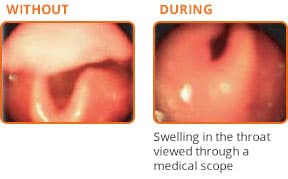Photo of a hereditary angioedema patient without and during an HAE swelling attack in the throat.